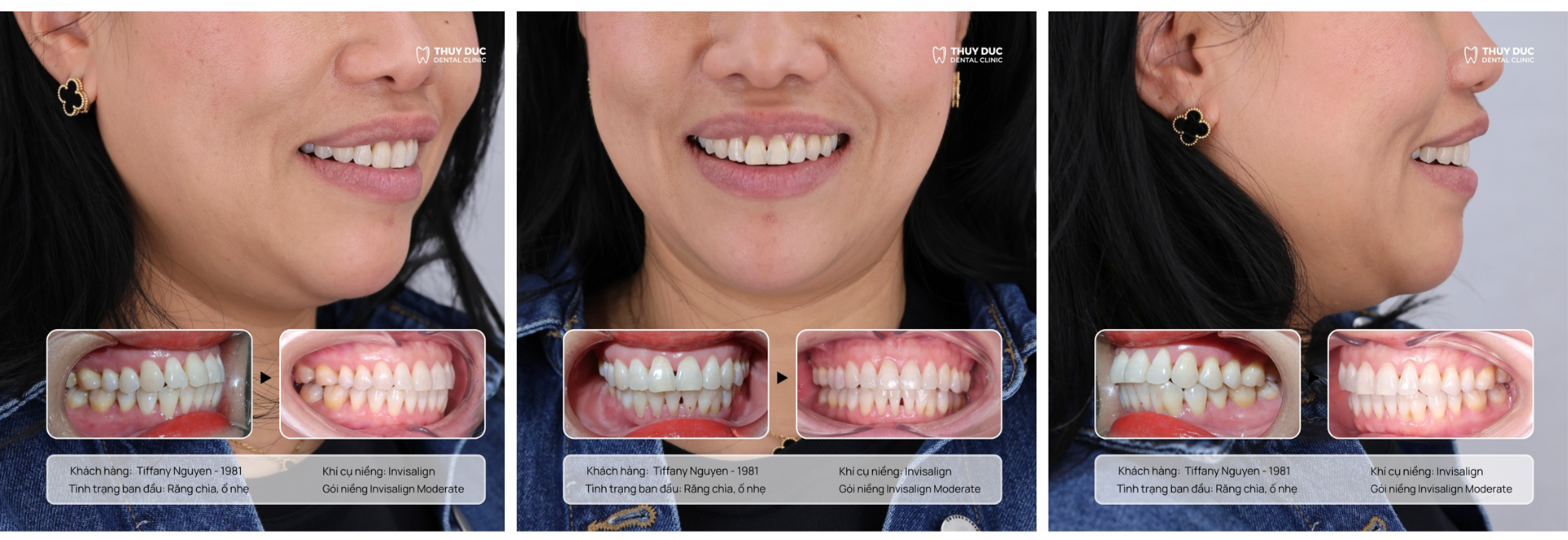 Vì sao người trưởng thành ngày càng chuộng niềng răng trong suốt Invisalign?- Ảnh 1.