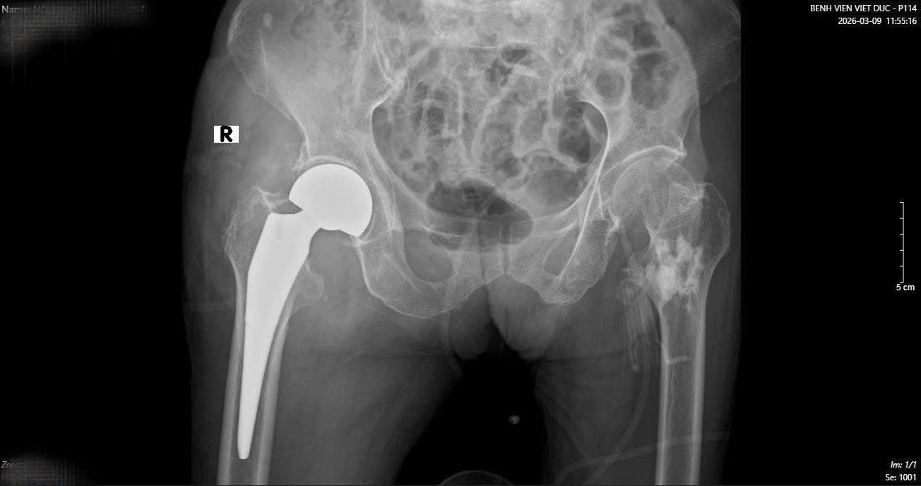 16 ngày, 2 cuộc đại phẫu cứu cụ bà 89 tuổi ở Bệnh viện Việt Đức- Ảnh 3.