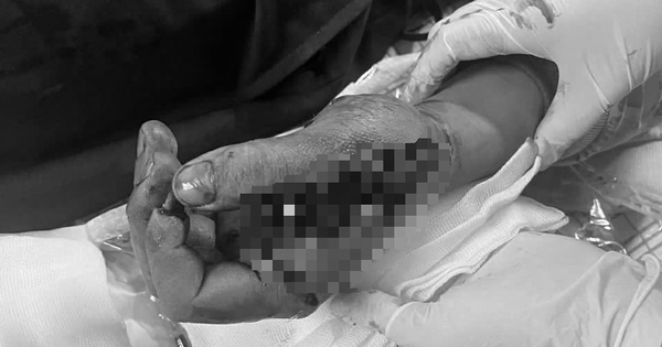 Tai nạn trong tích tắc vì pháo nổ, nam thanh niên suýt mất chức năng bàn tay