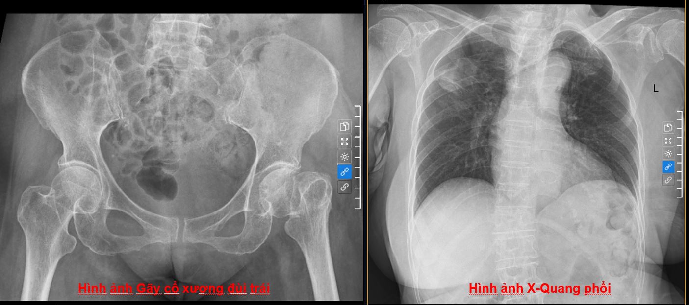 Tỷ lệ tử vong tới 30% sau gãy cổ xương đùi ở người cao tuổi: Vì sao cần điều trị sớm?- Ảnh 1.
