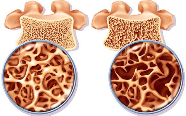 Yếu tố nguy cơ gây loãng xương