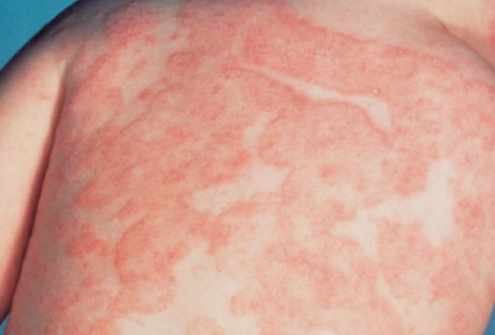 FDA phê duyệt idvynso điều trị HIV, mở thêm lựa chọn cho bệnh nhân đã ổn định virus- Ảnh 2. FDA phê duyệt idvynso điều trị HIV, mở thêm lựa chọn cho bệnh nhân đã ổn định virus- Ảnh 2.
