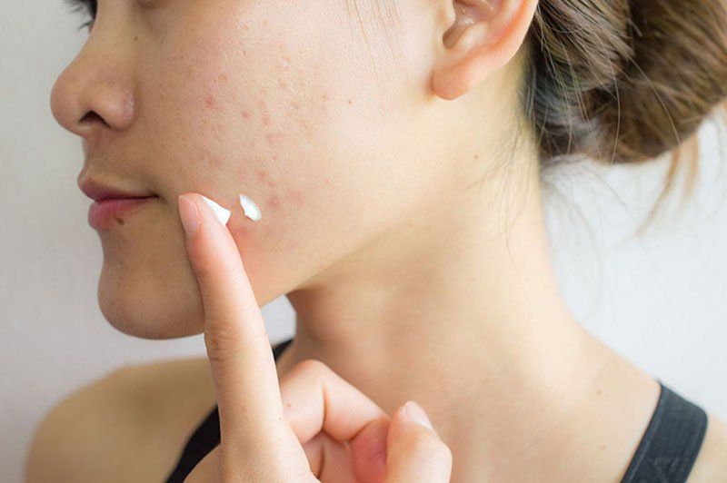 6 sai lầm khi chữa mụn trứng cá- Ảnh 1. 6 sai lầm khi chữa mụn trứng cá- Ảnh 1.
