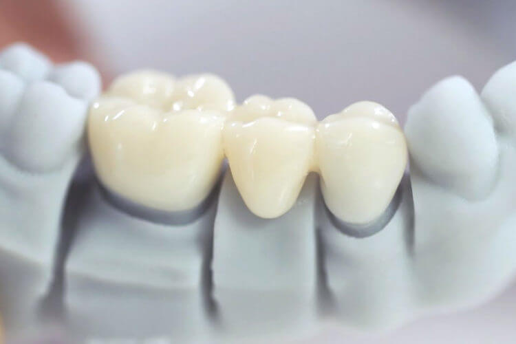 Bọc răng sứ bị viêm lợi (viêm nướu) thường xuất phát từ những sai sót trong kỹ thuật thực hiện hoặc thói quen chăm sóc sau khi bọc. Ảnh minh họa Bọc răng sứ bị viêm lợi (viêm nướu) thường xuất phát từ những sai sót trong kỹ thuật thực hiện hoặc thói quen chăm sóc sau khi bọc. Ảnh minh họa
