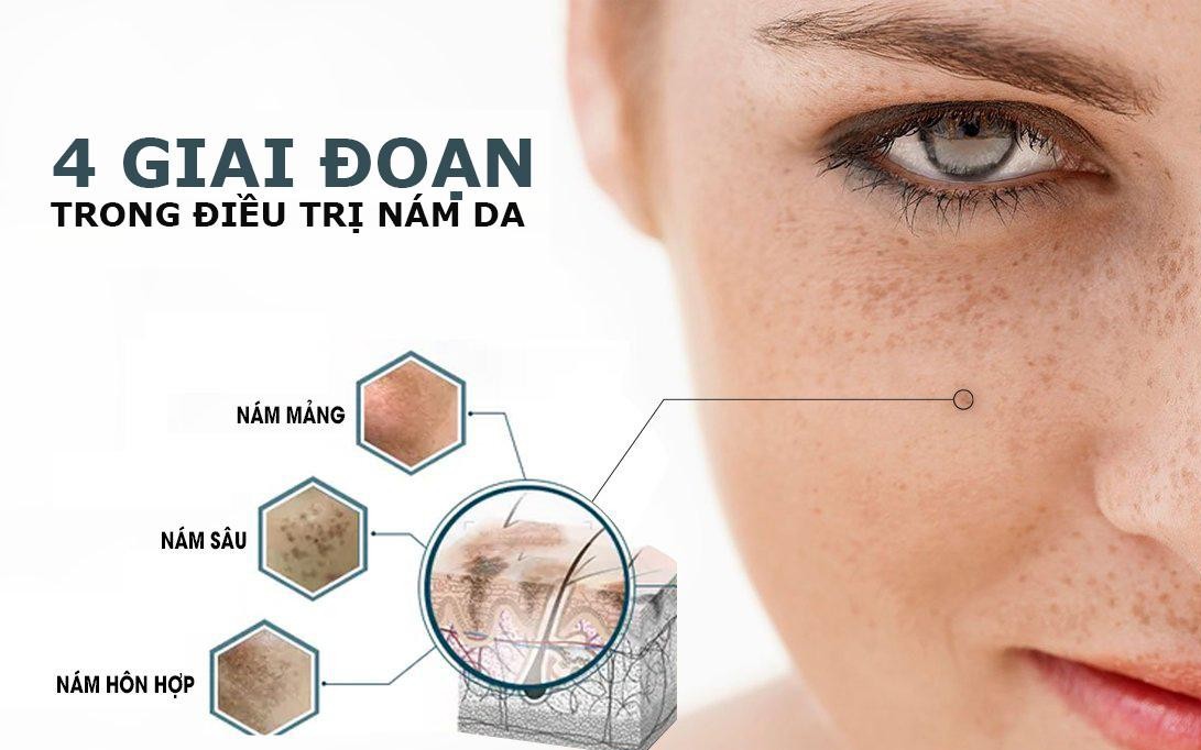 Mẹo chữa nám da từ rau má- Ảnh 3. Chữa nám da ở mức độ trung bình