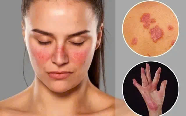 Khi bệnh tự miễn lupus ban đỏ không còn là 'án treo' suốt đời- Ảnh 2. Khi bệnh tự miễn lupus ban đỏ không còn là 'án treo' suốt đời- Ảnh 2.