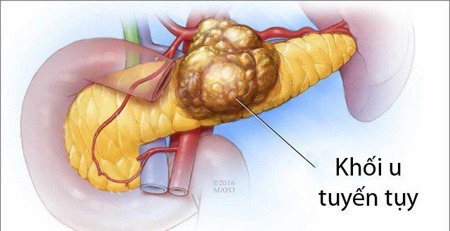 Các phương pháp điều trị u đầu tụy- Ảnh 1. U tụy ác tính: Vì sao khó chữa? | Vinmec