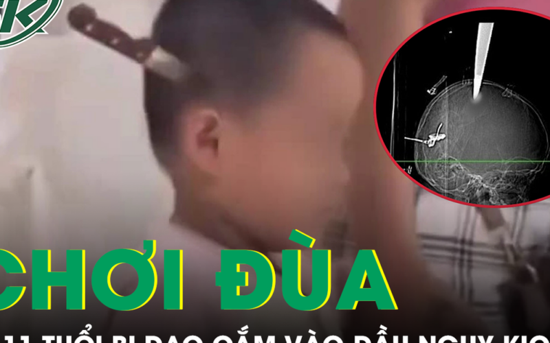 Hai anh em chơi đùa tại nhà, bé 11 tuổi bị dao cắm vào đầu nguy kịch