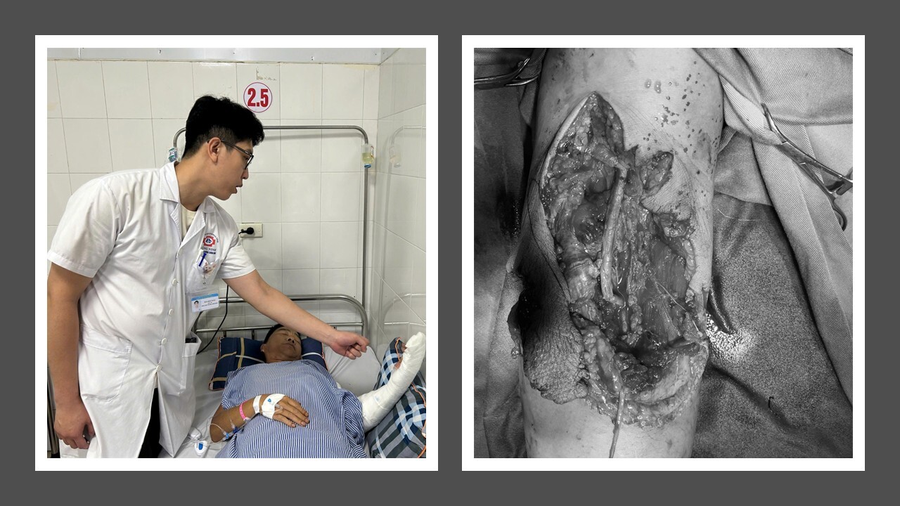 Phối hợp liên viện, cứu sống bệnh nhân đứt động mạch cánh tay- Ảnh 2. Phối hợp liên viện, cứu sống bệnh nhân đứt động mạch cánh tay- Ảnh 2.