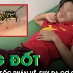 Ong vò vẽ đốt 70 vết, bé gái 10 tuổi sốc phản vệ, suy đa cơ quan phải cấp cứu gấp