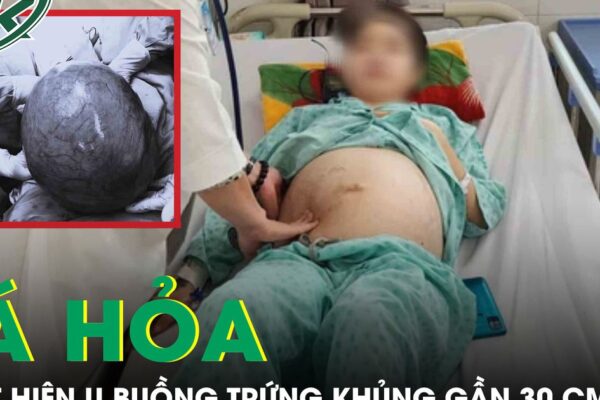 Tá hoả phát hiện khối u buồng trứng ‘cực khủng’ gần 30cm từ dấu hiệu đau bụng