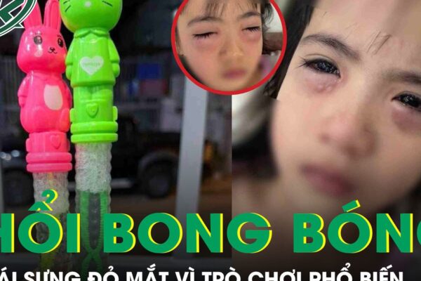 Chơi bong bóng xà phòng, bé gái 5 tuổi sưng đỏ 2 mắt phải cấp cứu khẩn