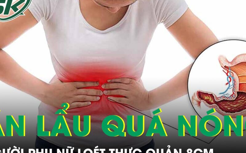 Người phụ nữ loét thực quản 8cm vì thói quen ăn lẩu quá nóng