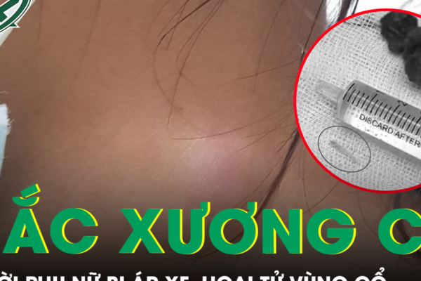 Xương cá nằm trong họng 5 tháng gây áp xe hoại tử vùng cổ
