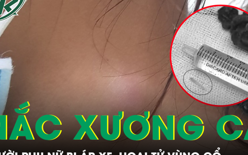 Xương cá nằm trong họng 5 tháng gây áp xe hoại tử vùng cổ