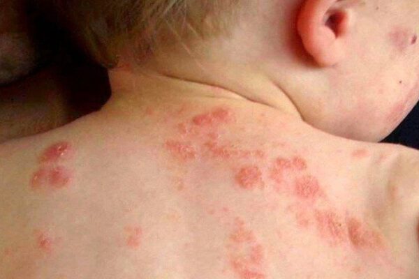 Bệnh chốc mùa hè: Nhận biết sớm để tránh biến chứng