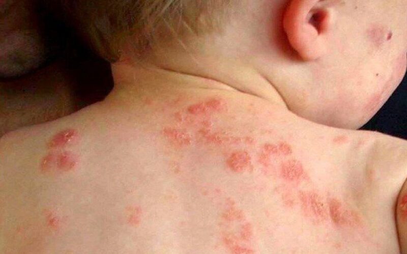 Bệnh chốc mùa hè: Nhận biết sớm để tránh biến chứng
