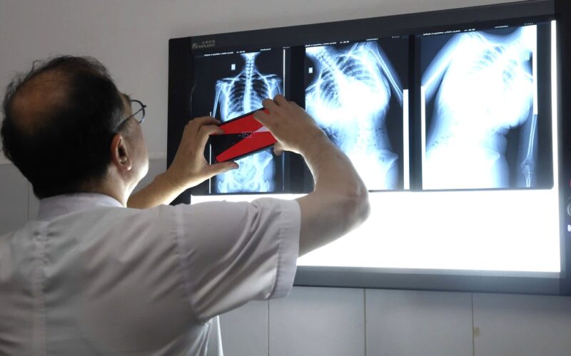 Dấu hiệu nhiều phụ huynh bỏ qua khiến trẻ biến dạng cột sống