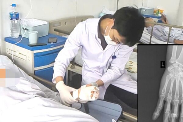 Vi phẫu cứu ngón tay đứt lìa cho nữ công nhân phụ hồ bị máy trộn bê tông cuốn nát bàn tay