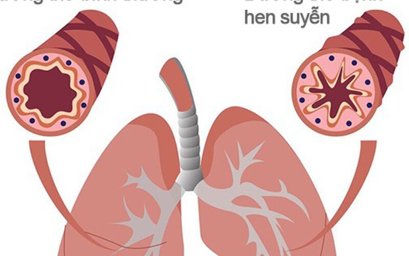 Khi nào người bệnh hen cần đến viện ngay lập tức?