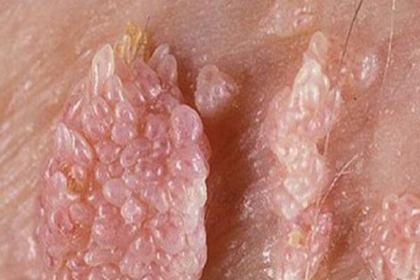 Dấu hiệu nhận biết sớm bệnh sùi mào gà ở phụ nữ
