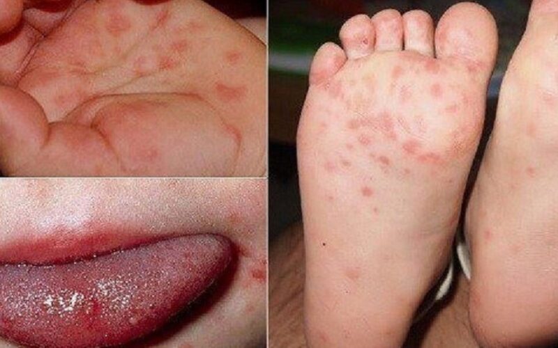 Khánh Hòa đã ghi nhận 2.254 ca tay chân miệng, bác sĩ khuyến cáo điều cần nhớ để phòng bệnh