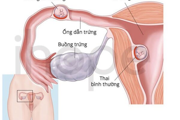 Hiếm gặp: Vừa có thai trong tử cung vừa có thai ngoài tử cung