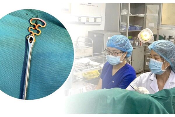 Bỏ quên vòng tránh thai suốt 30 năm, người phụ nữ 63 tuổi gặp biến chứng phụ khoa