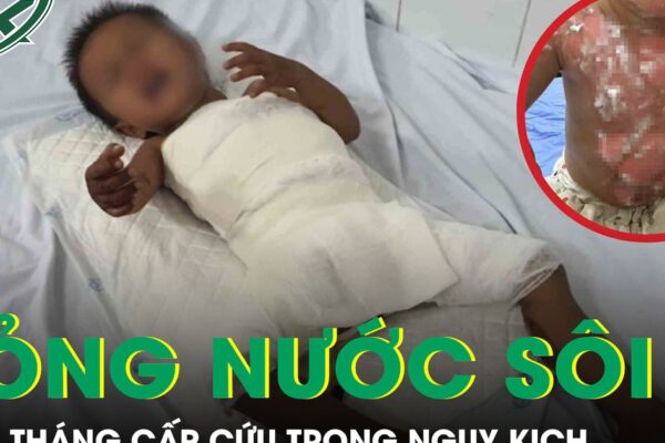 Bé 22 tháng tuổi bỏng nước sôi cấp cứu trong nguy kịch