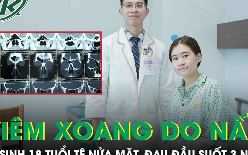 Viêm xoang do nấm, nữ sinh 18 tuổi tê nửa mặt, đau đầu suốt 3 năm