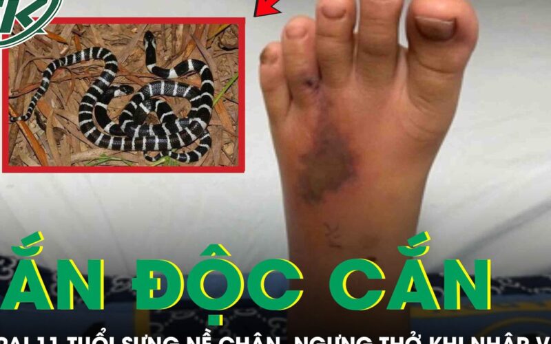 Bé trai 11 tuổi bị rắn độc cắn, sưng nề chân, ngưng thở khi nhập viện