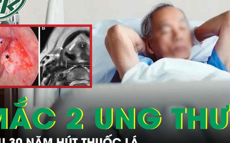 Người đàn ông 56 tuổi mắc cùng lúc hai ung thư sau 30 năm hút thuốc lá