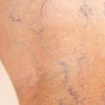 8 cách giúp cải thiện bệnh suy giãn tĩnh mạch tại nhà