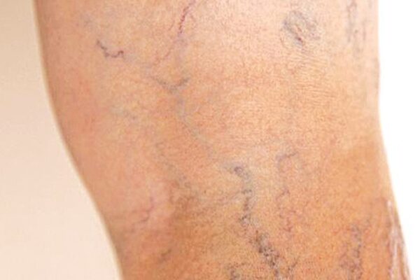 8 cách giúp cải thiện bệnh suy giãn tĩnh mạch tại nhà