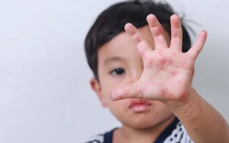 Vì sao bệnh tay chân miệng tăng mạnh ở trẻ mầm non vào đầu tuần?
