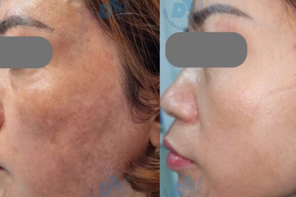 Bác sĩ chỉ rõ lý do nhiều người trị nám tốn kém nhưng vẫn tái phát