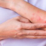 Nắng nóng khiến nguy cơ viêm da gia tăng, phòng ngừa thế nào?