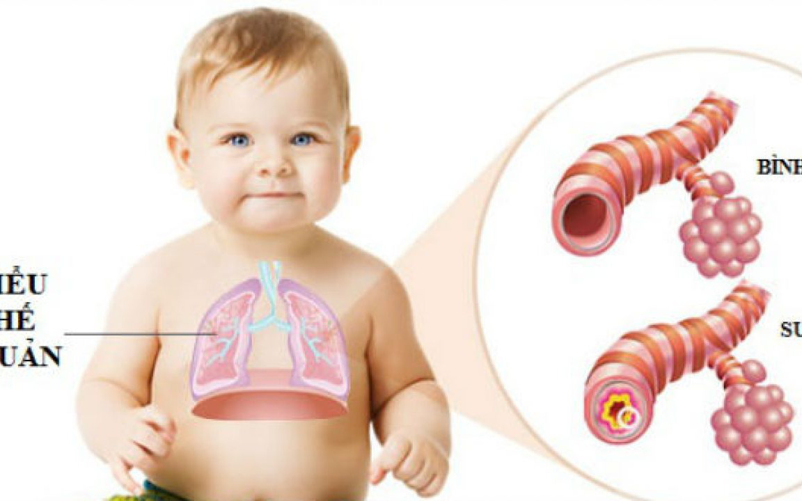 Nguyên nhân khiến trẻ hay mắc viêm phế quản và cách chăm sóc đúng