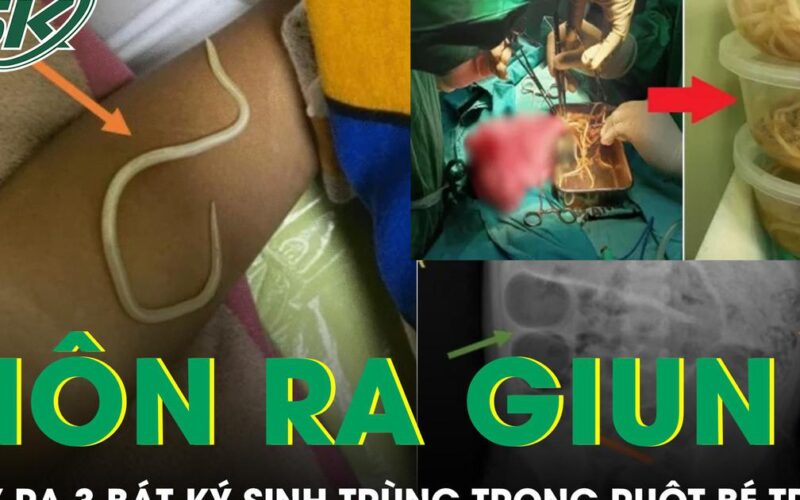 Bé trai 3 tuổi nôn ra giun, bác sĩ phẫu thuật lấy ra 3 bát ký sinh trùng trong ruột
