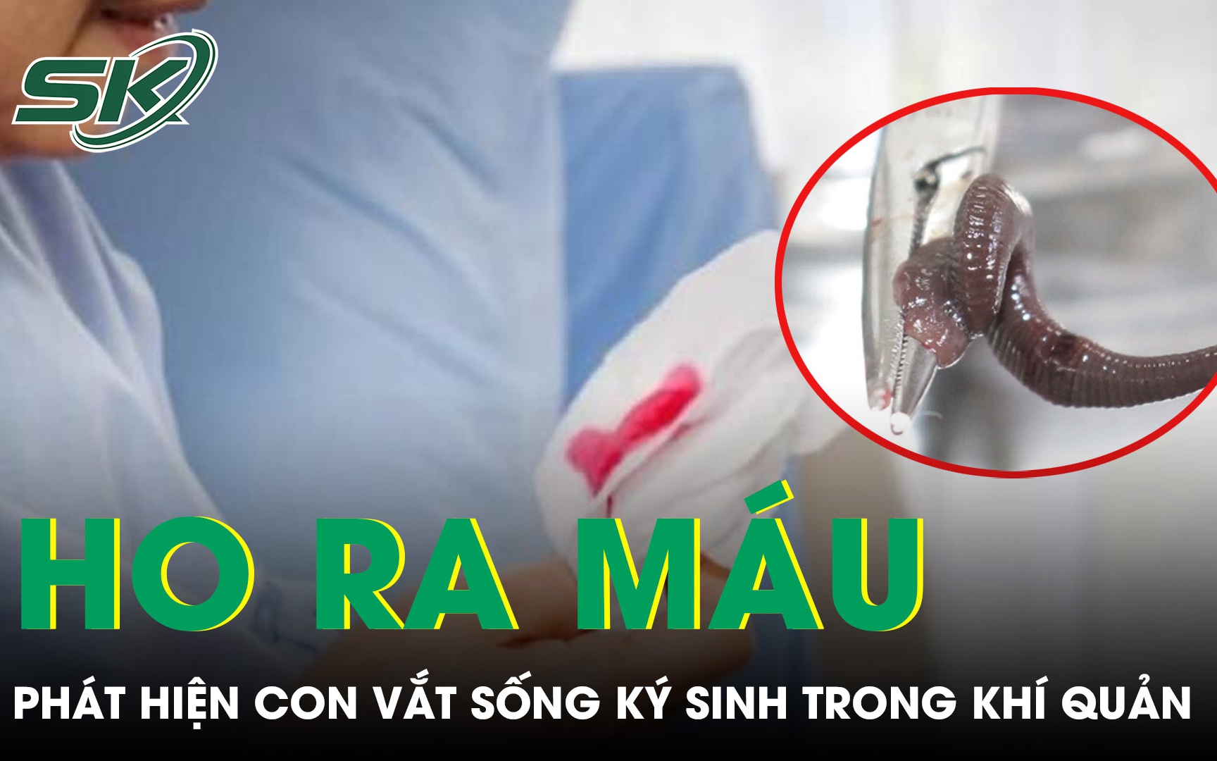 Ho ra máu suốt một tháng, bàng hoàng phát hiện con vắt sống ký sinh trong khí quản
