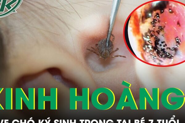 Kinh hoàng phát hiện ổ ve chó ký sinh trong tai bé trai 7 tuổi