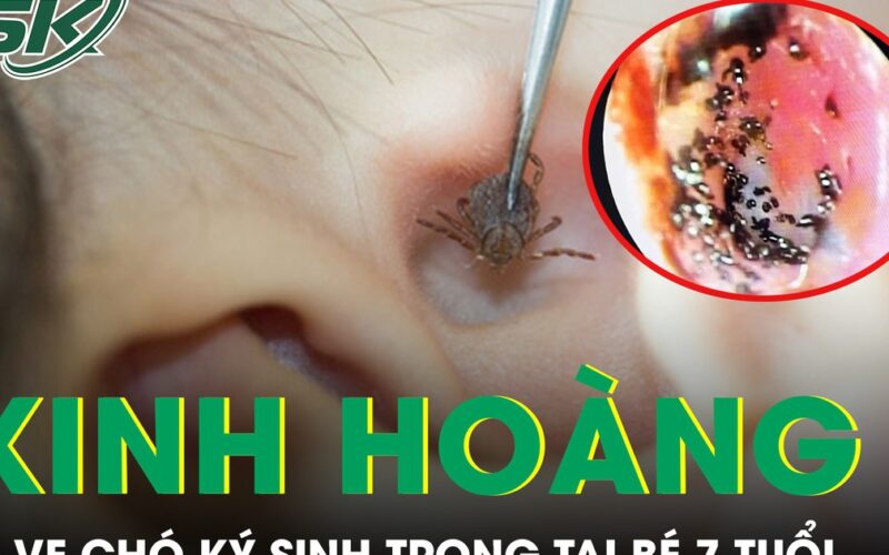 Kinh hoàng phát hiện ổ ve chó ký sinh trong tai bé trai 7 tuổi