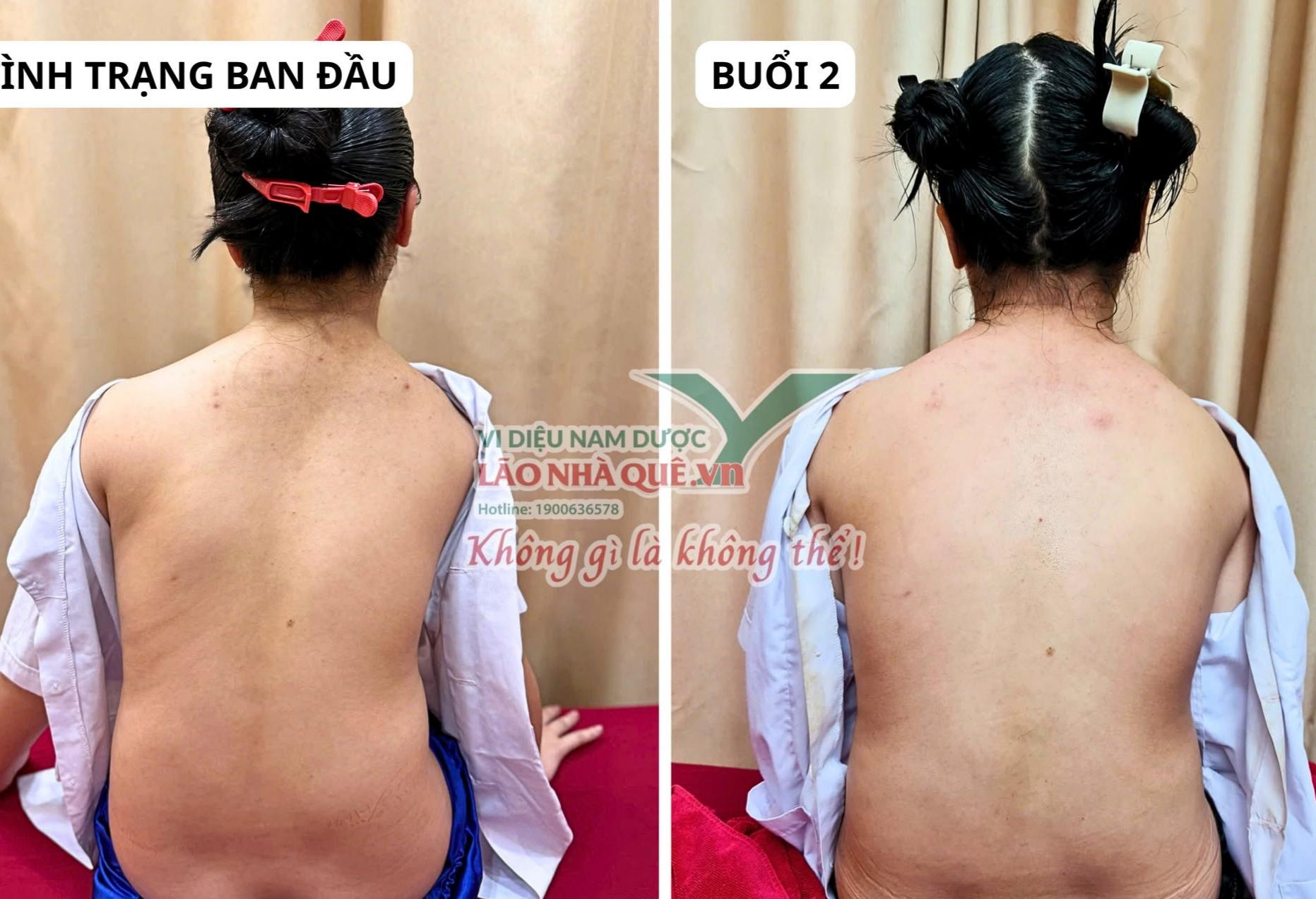 benh-nhan-15-tuoi-su-dung-phuong-phap-khai-thong-cot-song-cua-lao-nha-que1-1780902980325443141261 Tìm hiểu nguyên lý 'Khai thông cột sống' của Lão Nhà Quê- Ảnh 2.