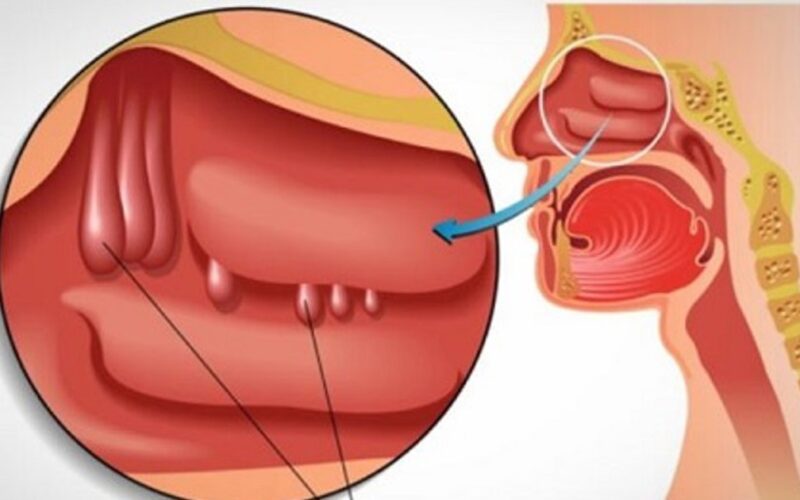 Nghẹt mũi, khó thở là biểu hiện của bệnh gì?