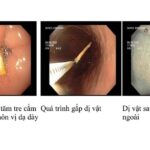 Thói quen ngậm tăm sau ăn hệ lụy khó lường