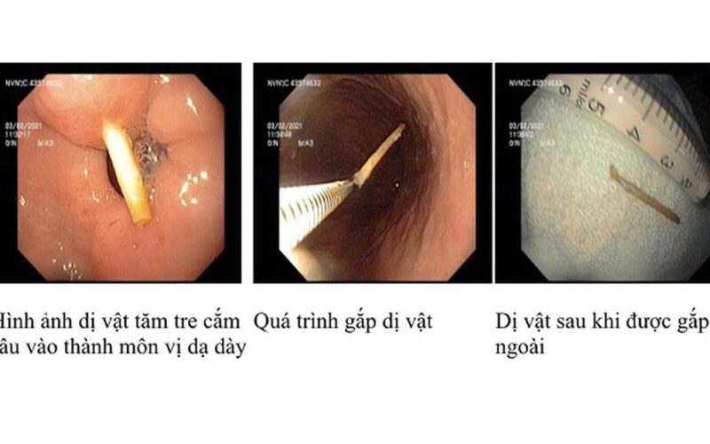 Thói quen ngậm tăm sau ăn hệ lụy khó lường