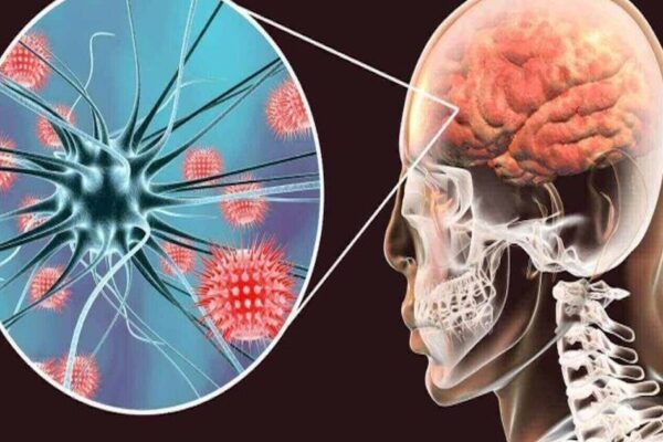 Viêm não tự miễn có nguy cơ tử vong cao nếu chẩn đoán muộn