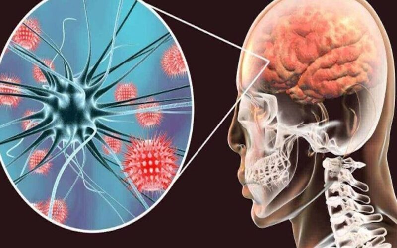 Viêm não tự miễn có nguy cơ tử vong cao nếu chẩn đoán muộn