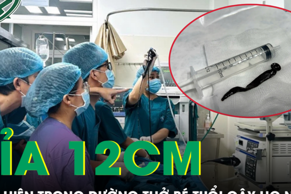 Bé 8 tuổi ho nhiều, bác sĩ phát hiện con đỉa dài hơn 12 cm trong đường thở