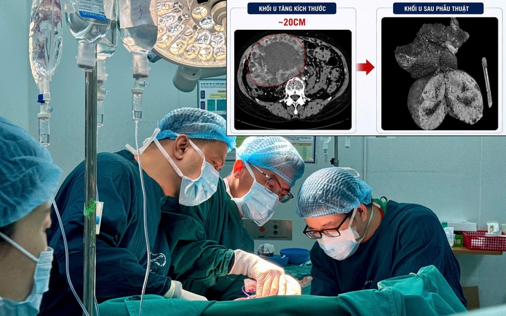 Từng phải dùng 12 chiếc bỉm/ngày, cụ ông 76 tuổi phục hồi ngoạn mục sau mổ tiền liệt tuyến- Ảnh 2.